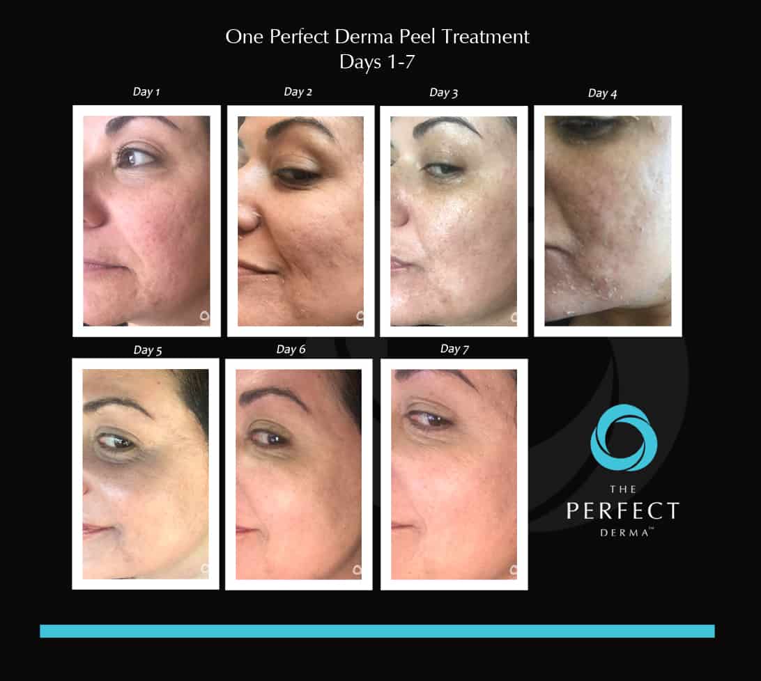 Perfect Derma Peel Results
